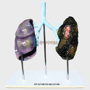 폐의 비교(정상폐와 흡연폐)